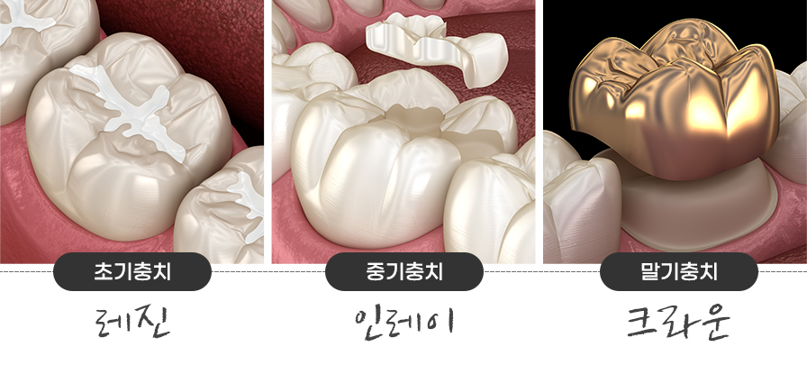 미룰수록 어려운 충치치료, 초기에 치료해요! 관련 이미지 4