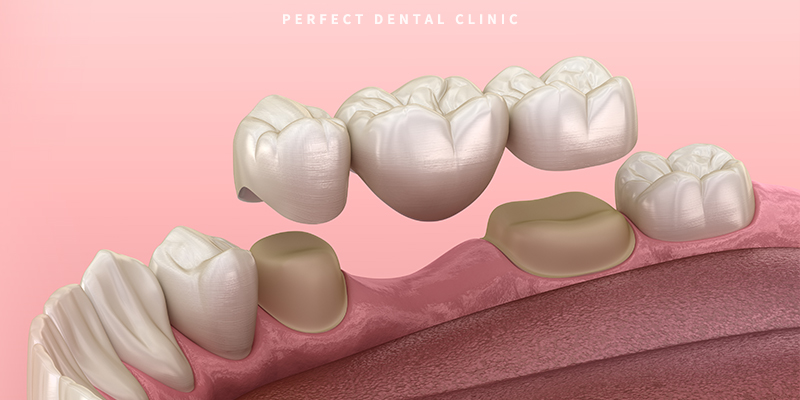 치과 앞니 브릿지 가격 관련 이미지 3