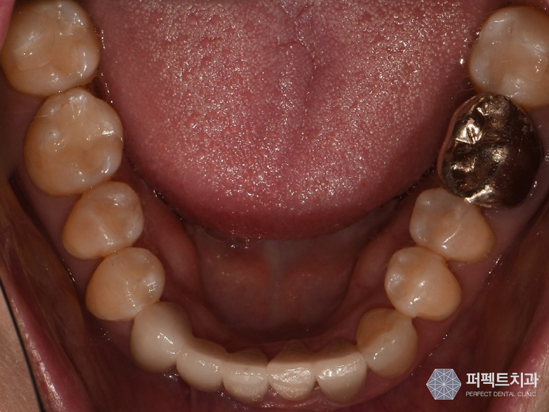 충치치료 치아크라운비용 관련 이미지 3