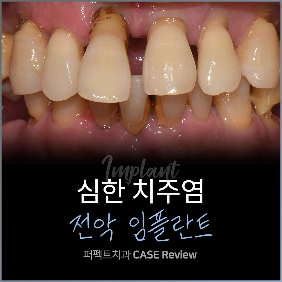 전악 임플란트 비용 궁금하다면 관련 이미지 1