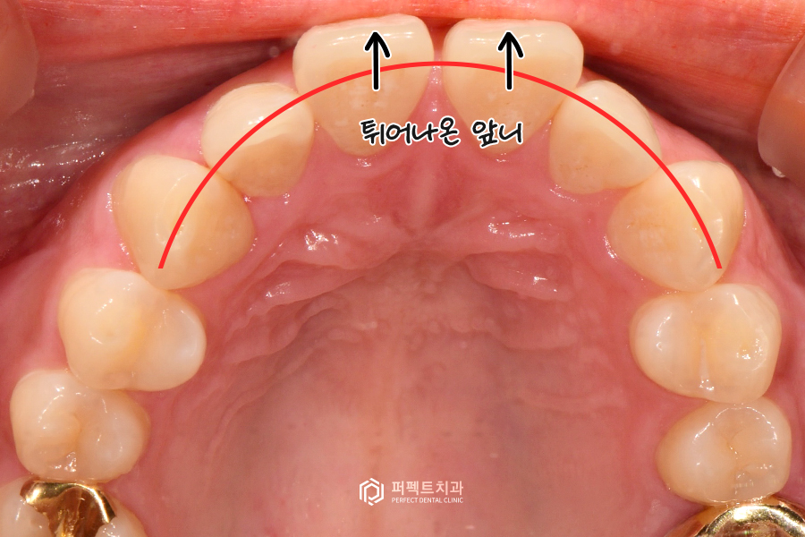앞니 돌출 있는데 폴리네이트로 극복 가능..?🤔 관련 이미지 3