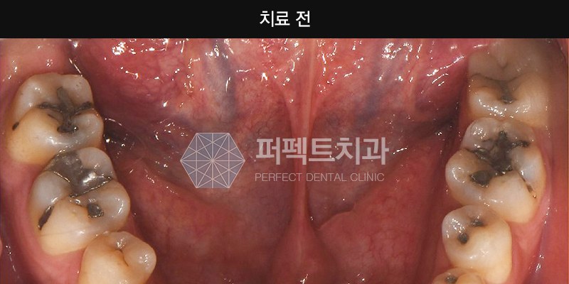 지르코니아 크라운 가격 궁금해? 관련 이미지 3