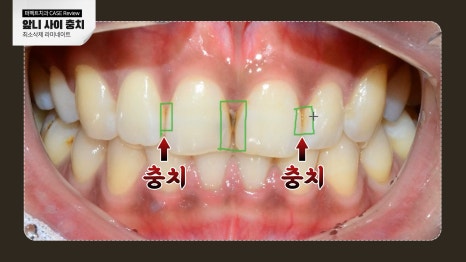 앞니 사이 충치치료와 폴리네이트 관련 이미지 3