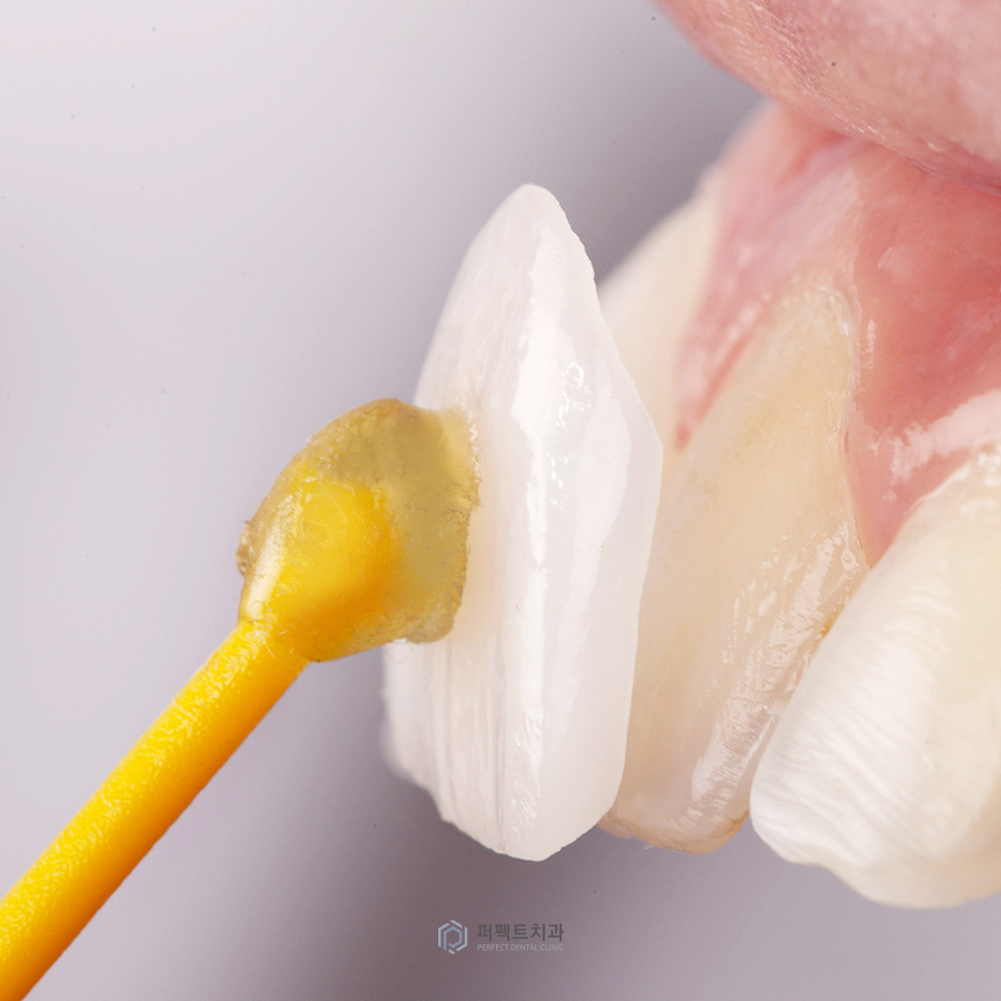 특별한✨ 라미네이트가 있을까? 관련 이미지 2