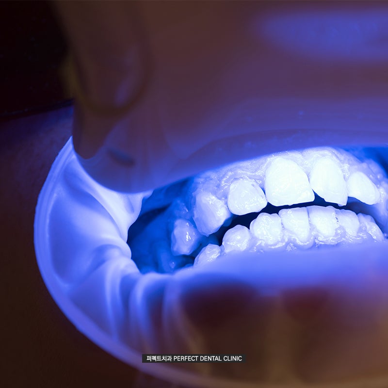 치아미백 후 주의사항(feat.과정, 통증) 관련 이미지 2
