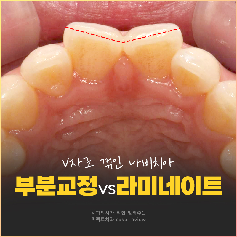 나비치아, 부분교정vs라미네이트 치과의사가 추천하는 방법은? 관련 이미지 1