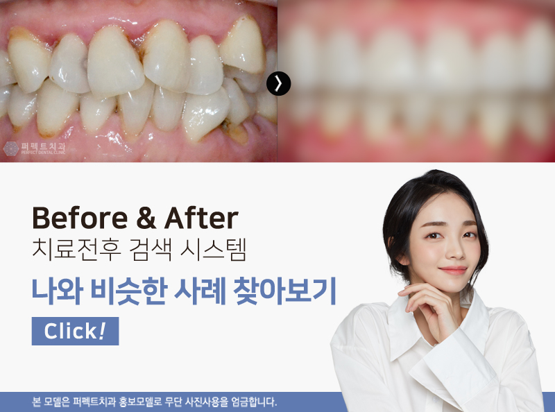 변색된 레진 치료방법 (feat.최소삭제라미네이트) 관련 이미지 2