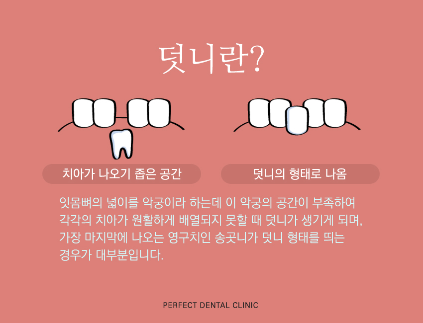 덧니부분교정 후기 좋은 치과 관련 이미지 1