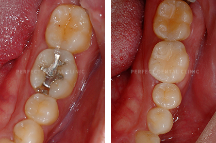 강남 충치치료비용 알고가자! 관련 이미지 5