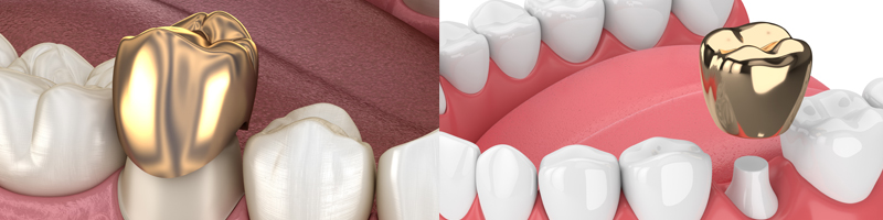 지르코니아 크라운 vs 골드크라운 vs PFM크라운 관련 이미지 3