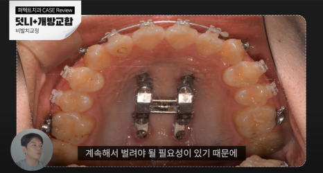 비발치로 덧니,개방교합 교정하기! 관련 이미지 5