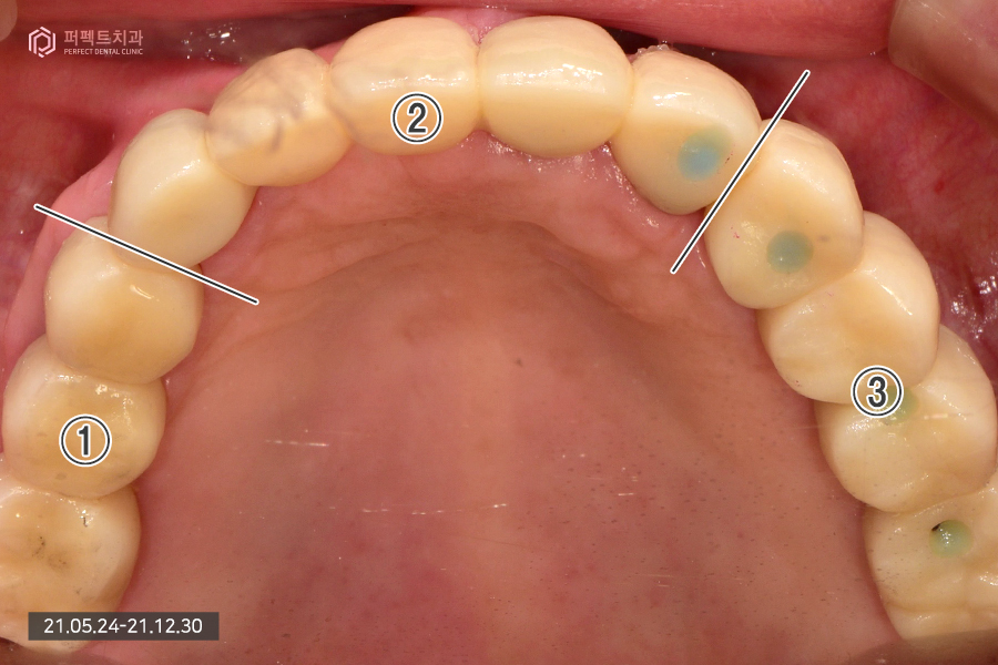 치아가 하나도 없을 때 필요한 전악임플란트😬 관련 이미지 7