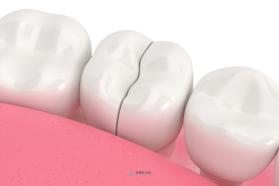 치아크랙｜치아에 금이 갔을 때 나타나는 증상은? 관련 이미지 4