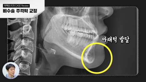비수술 주걱턱 교정 결과 관련 이미지 1