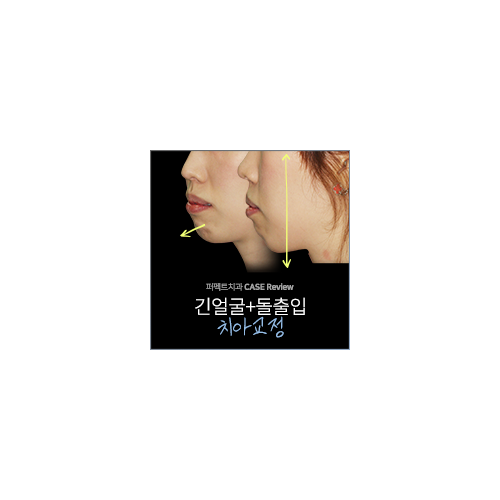 긴턱 치아교정, 턱변화 비교 관련 이미지 4