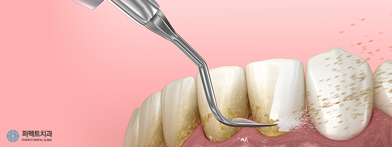스케일링 후 주의사항과 오해 관련 이미지 3