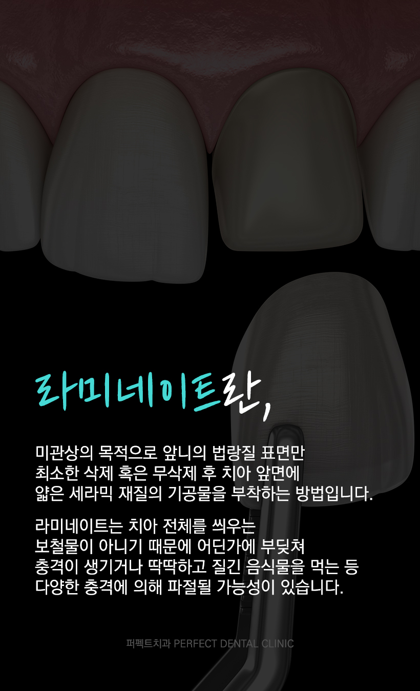 이갈이 하는데 라미네이트 가능한가요? 관련 이미지 1