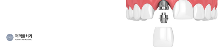 임플란트 전 고려해야 할 사항은? 관련 이미지 3