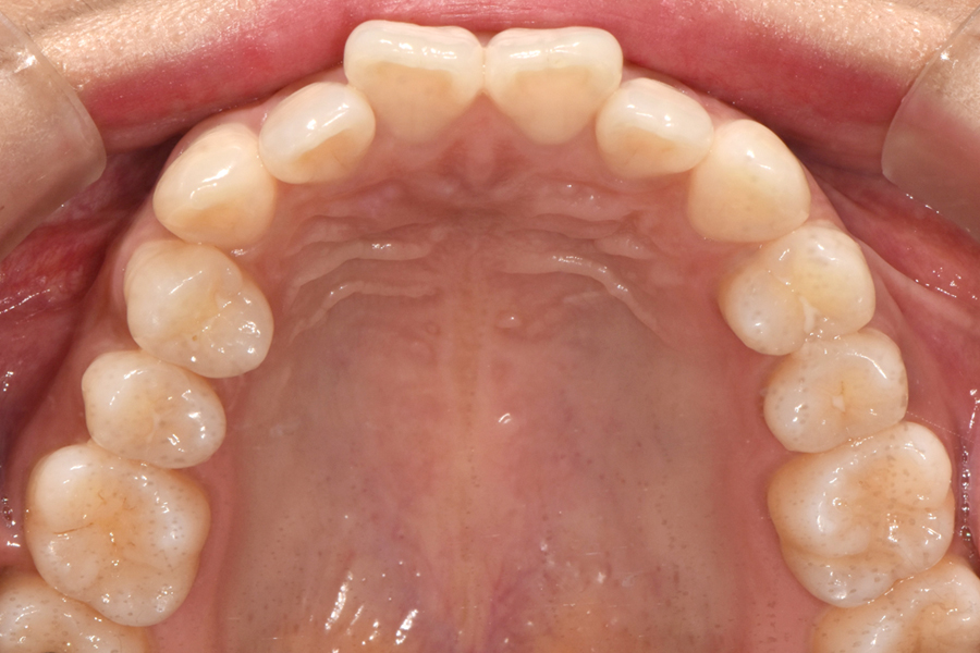 클리피씨를 이용한 부분교정, 얼마나 걸릴까? 관련 이미지 3