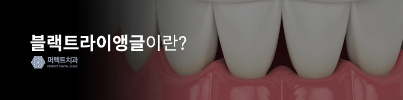 블랙트라이앵글, 치경부마모증 치과치료! 관련 이미지 2