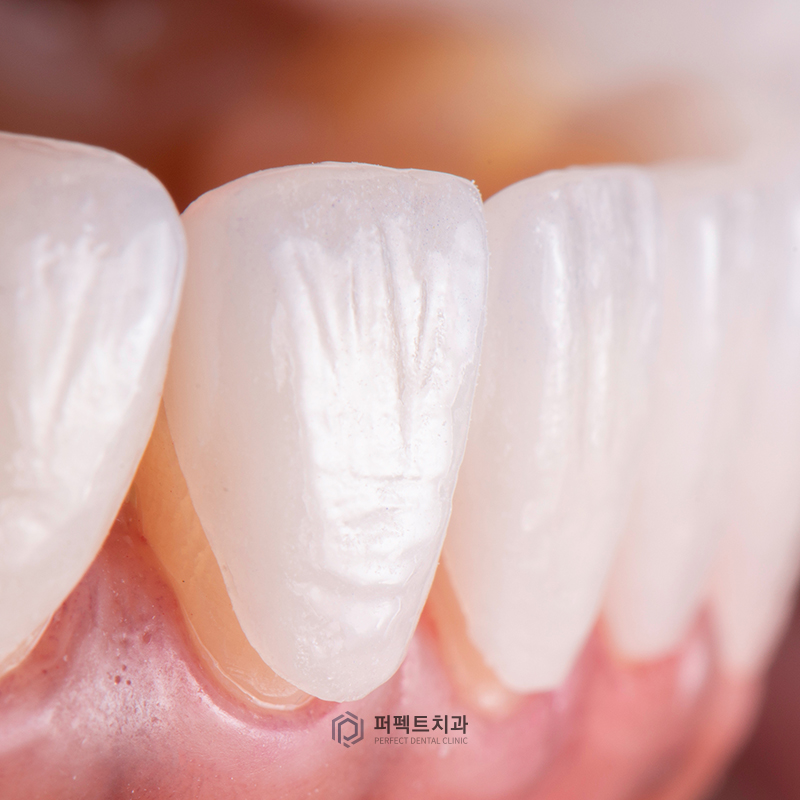 라미네이트 후 치아교정 시 알아아야 할 점은? 관련 이미지 3