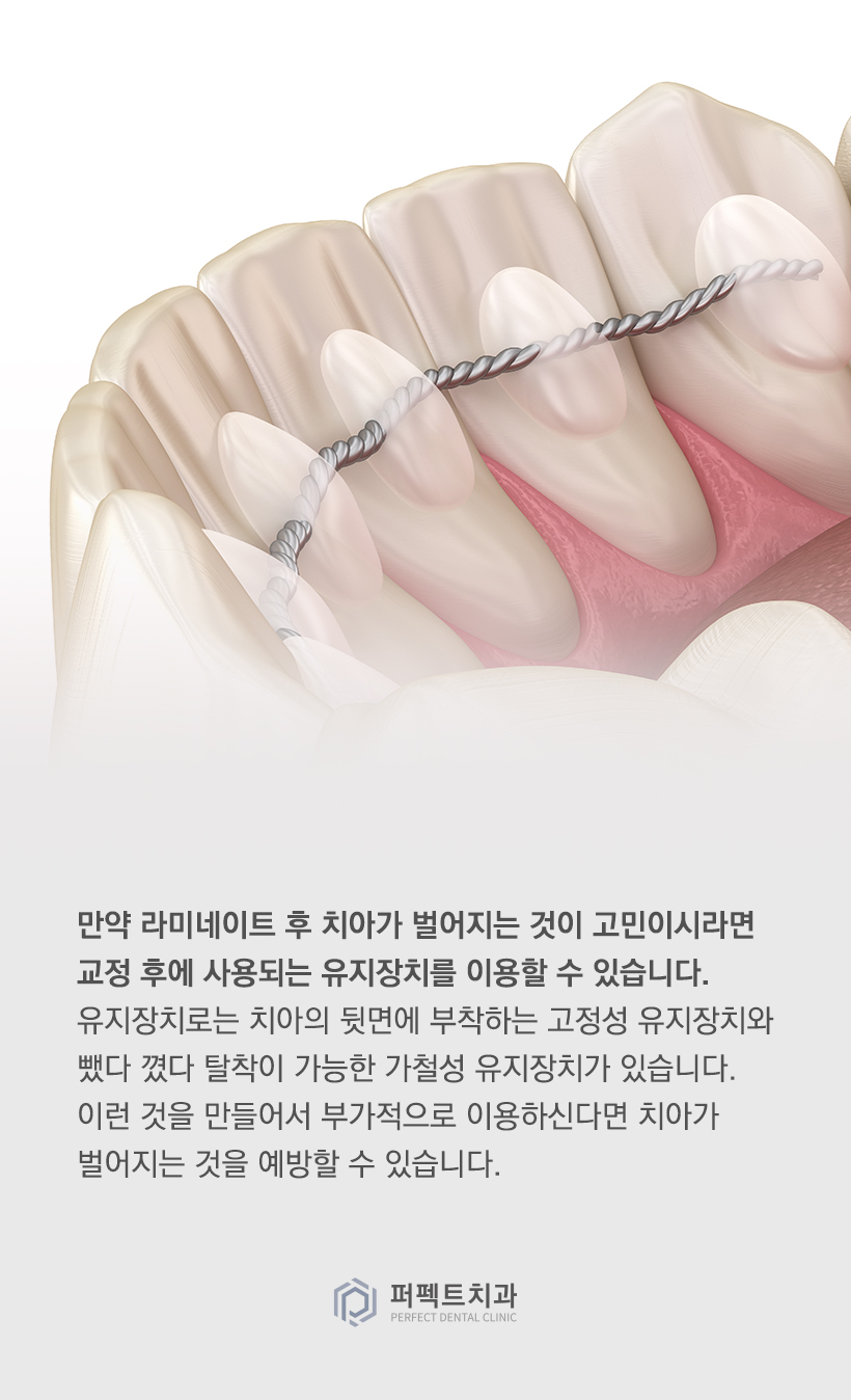 라미네이트를 했는데 앞니가 벌어졌어요! 관련 이미지 5