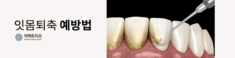 잇몸퇴축 원인과 문제점은? 관련 이미지 3