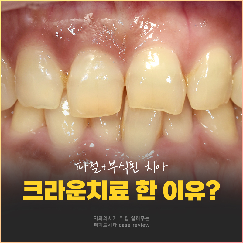 파절+부식된 치아, 크라운이 필요했던 이유는? 관련 이미지 1