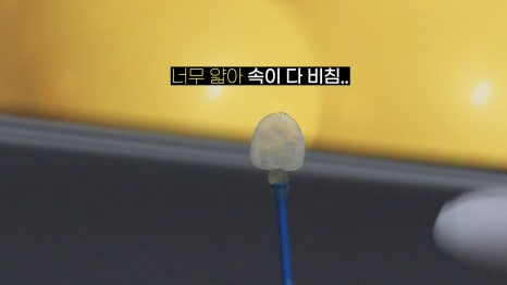 앞니 라미네이트 가격과 두께의 진실 관련 이미지 3
