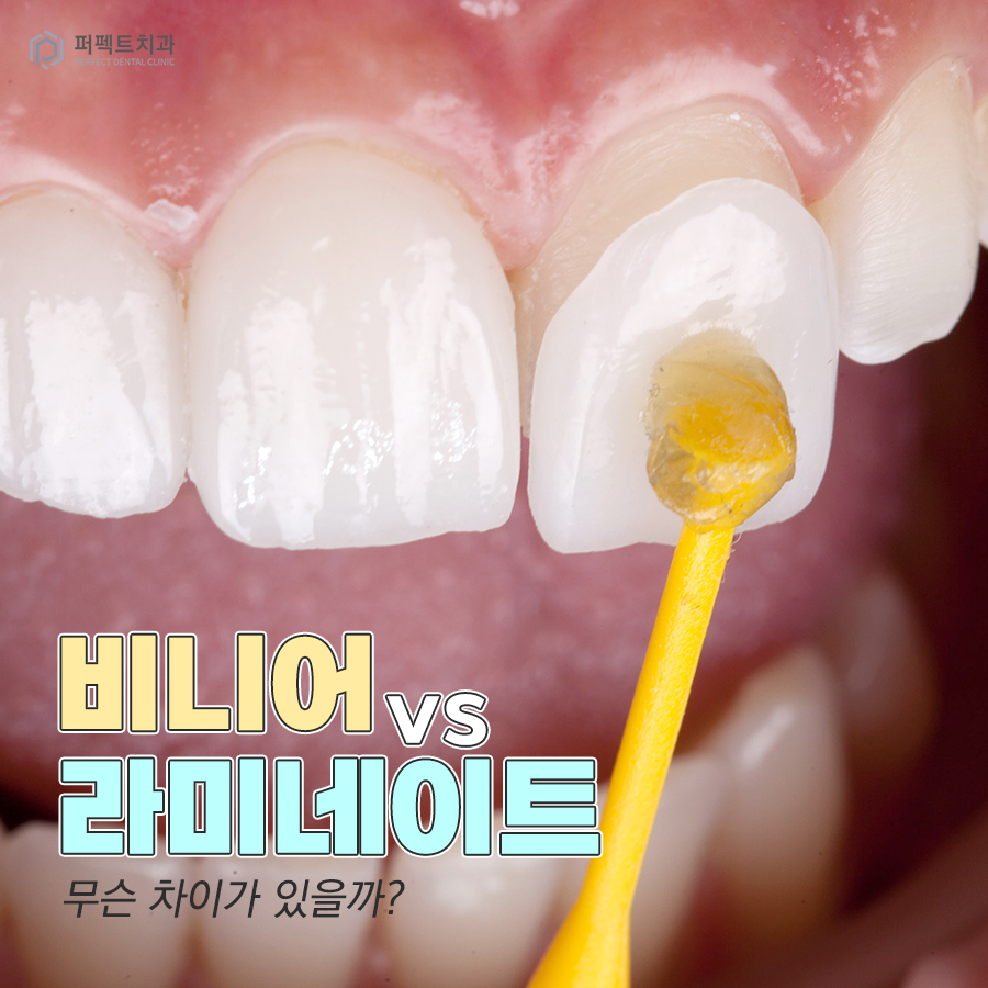 비니어와 라미네이트는 무슨 차이가 있나요? 관련 이미지 1