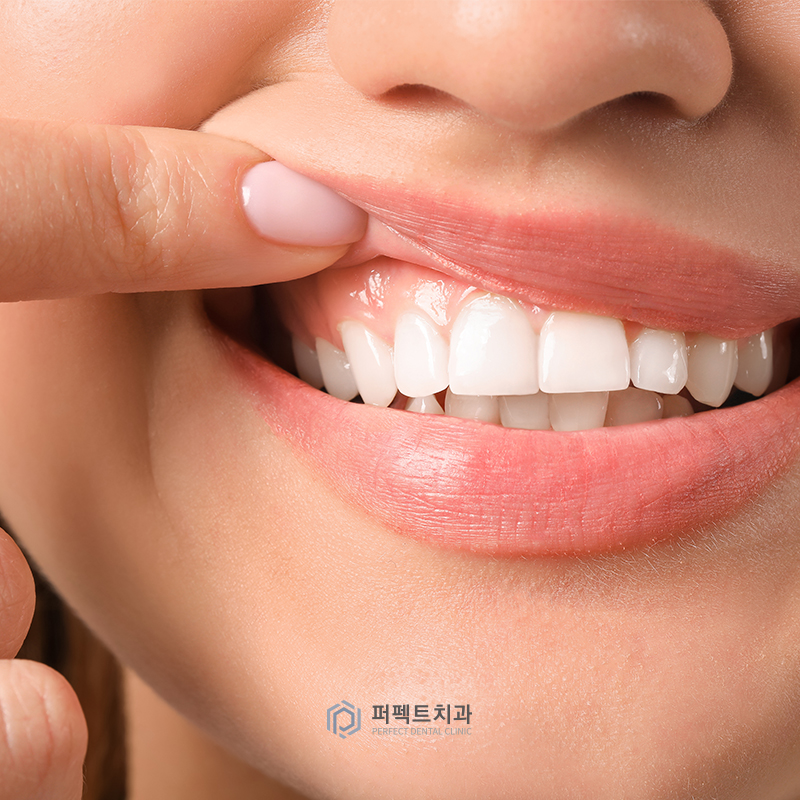 발치까지 이어질 수 있는 치주질환, 미리 예방하자! 관련 이미지 3