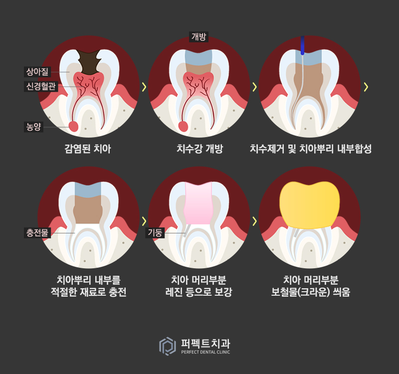 강남치과 치아 신경치료 후 통증 관련 이미지 2