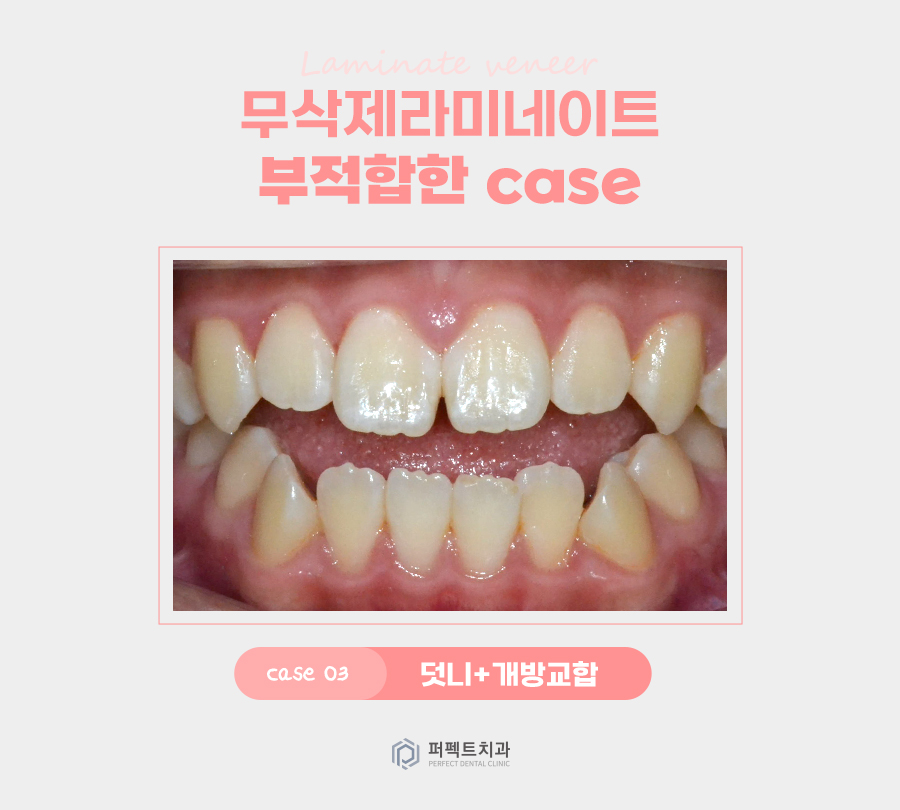 최소삭제, 무삭제 라미네이트가 적합하지 않은 경우는? 관련 이미지 5