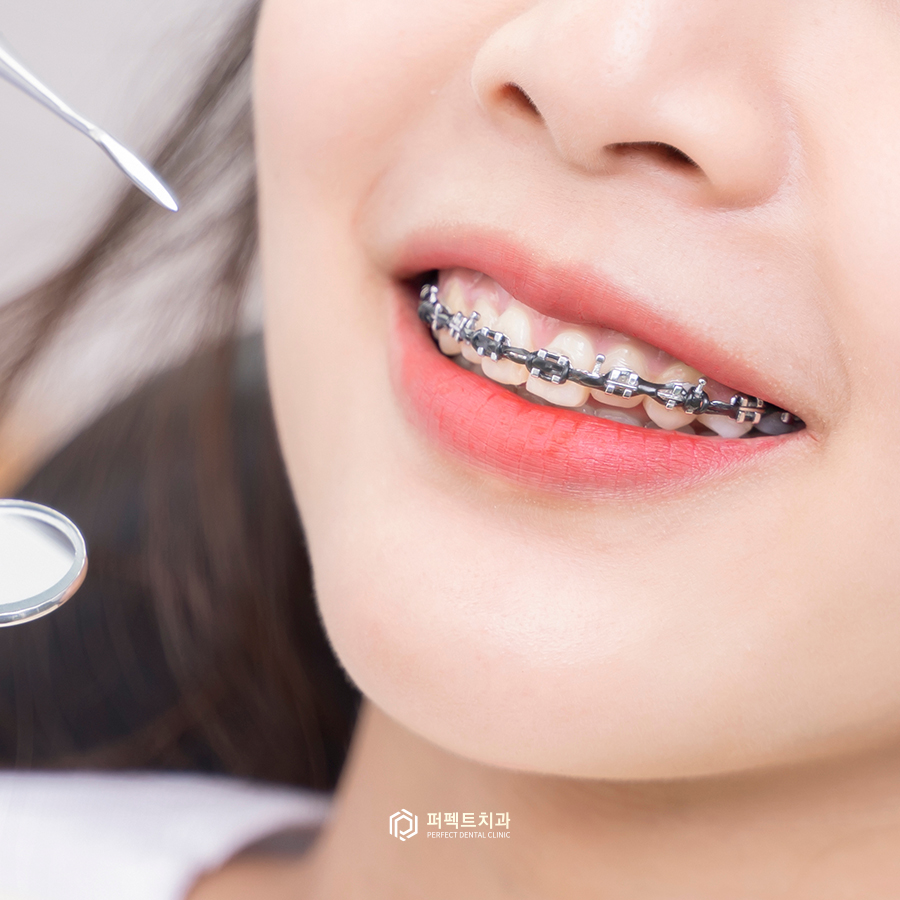 치아교정vs라미네이트, 대상은 어떻게 될까요? 관련 이미지 2