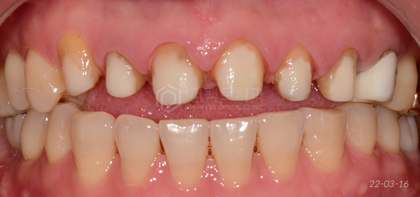 라미네이트를 뜯어보니😨..충격주의 #앞니신경치료 관련 이미지 6