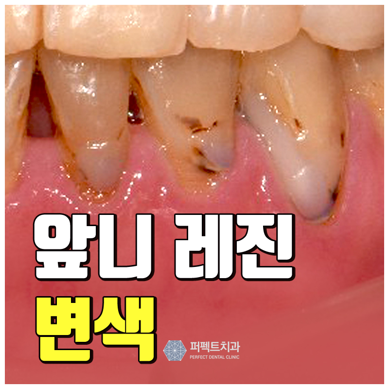앞니 레진 변색, 라미네이트 or 크라운? 관련 이미지 1