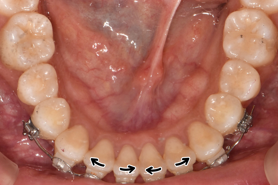 클리피씨를 이용한 부분교정, 얼마나 걸릴까? 관련 이미지 7