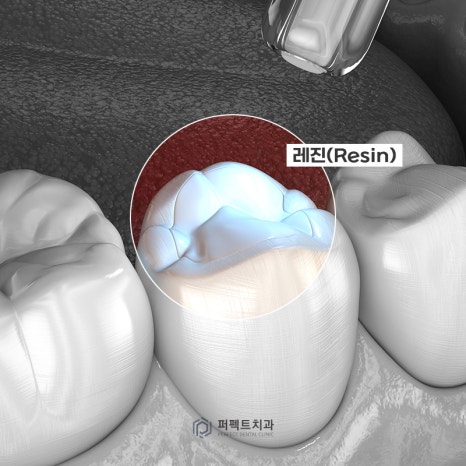 치과 치료 후 이가 시려요! 괜찮은건가요? 관련 이미지 2