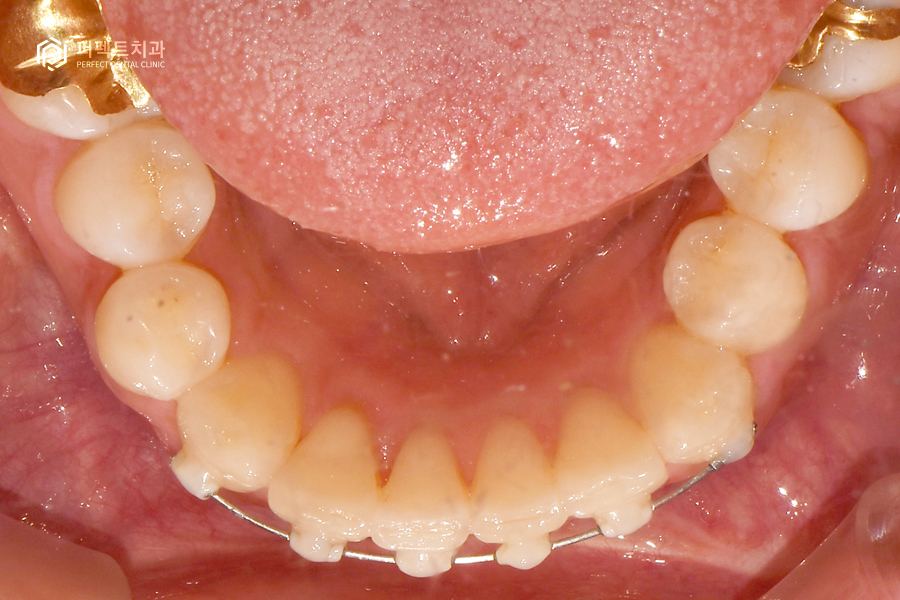 삐뚤거리는 아랫니를 6개월만에 반듯하게?! 관련 이미지 6