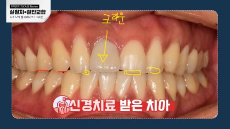 남자라미네이트 치료 결과는? 관련 이미지 4