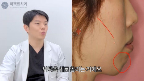 긴얼굴교정 수술없이 해결! 관련 이미지 2