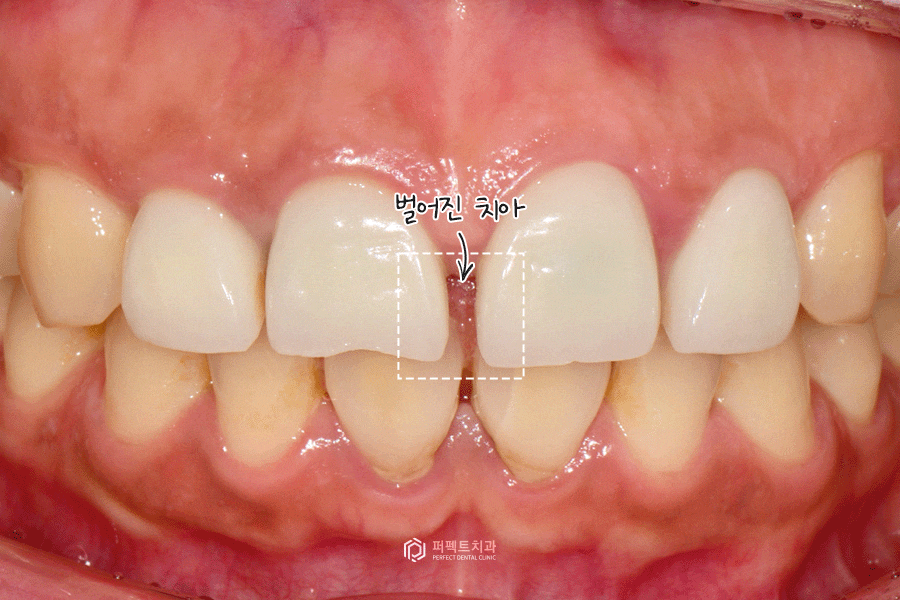 치료해도 자꾸 벌어지는 치아..😨 원인은? 관련 이미지 2