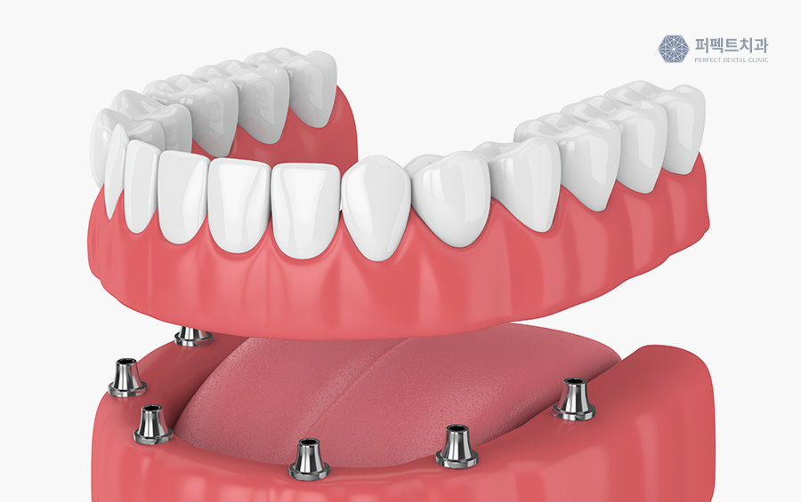 임플란트 시 가장 많이 하는 질문 Best 관련 이미지 4