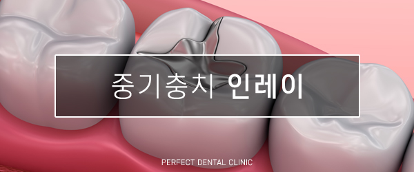 충치치료 비용 얼마인가요? 관련 이미지 5