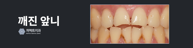깨진 앞니 치료, 라미네이트로! 관련 이미지 2