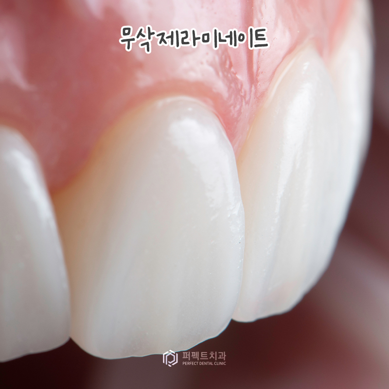 일반 라미네이트 vs 무삭제 라미네이트, 어떤 차이점이? 관련 이미지 3