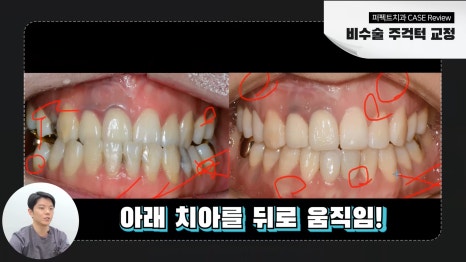 개방교합 주걱턱 교정 후기 관련 이미지 4