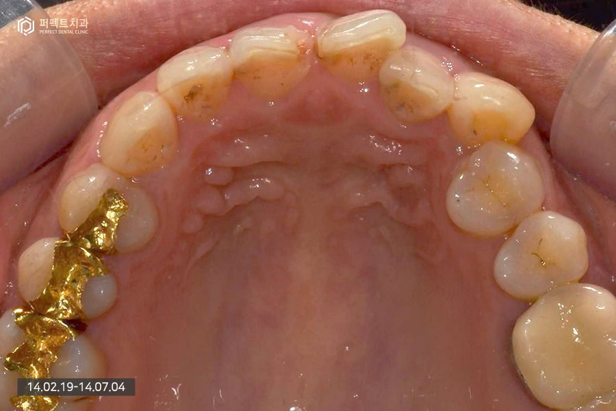 충치치료+교정 후 라미네이트, 세가지 복합적인 치료의 기간은?! 관련 이미지 3