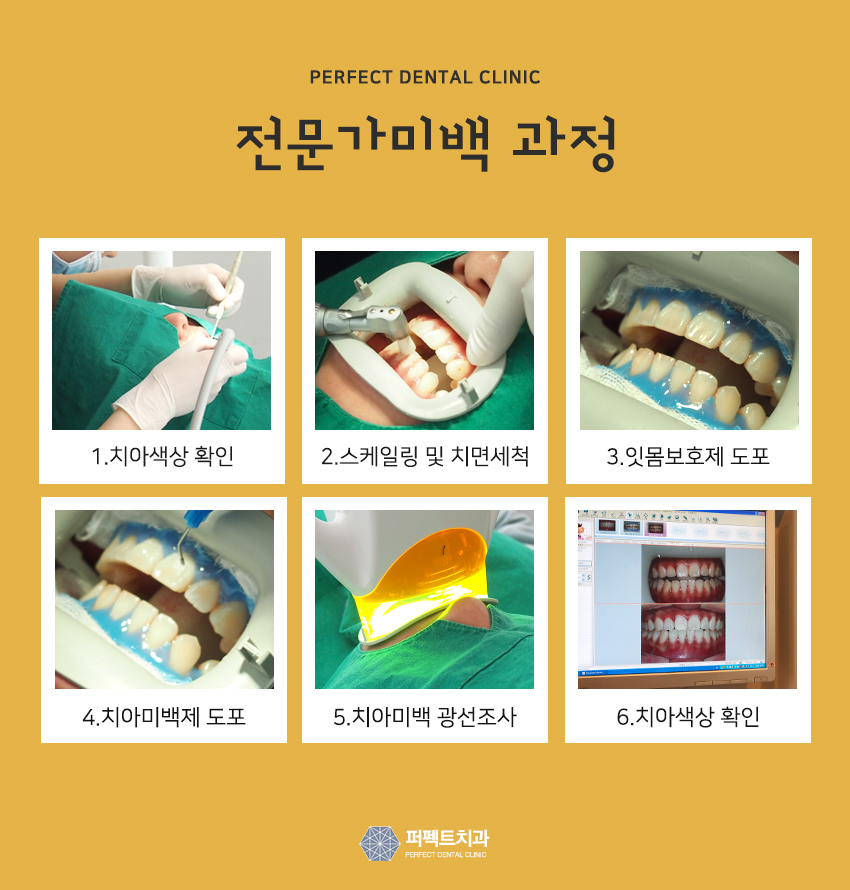 원데이치아미백 시술로 하얀이 만들자! 관련 이미지 5