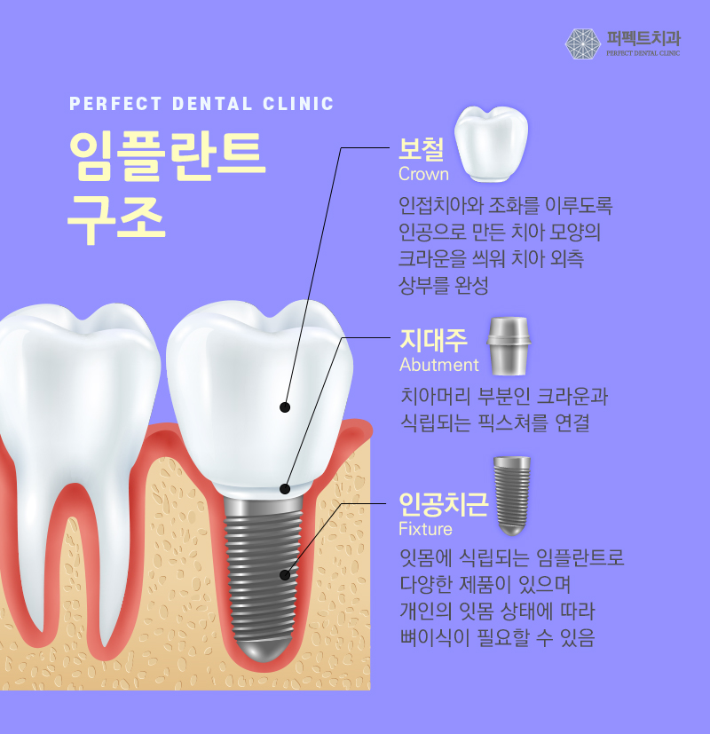 보험 임플란트 알아보기! 관련 이미지 5